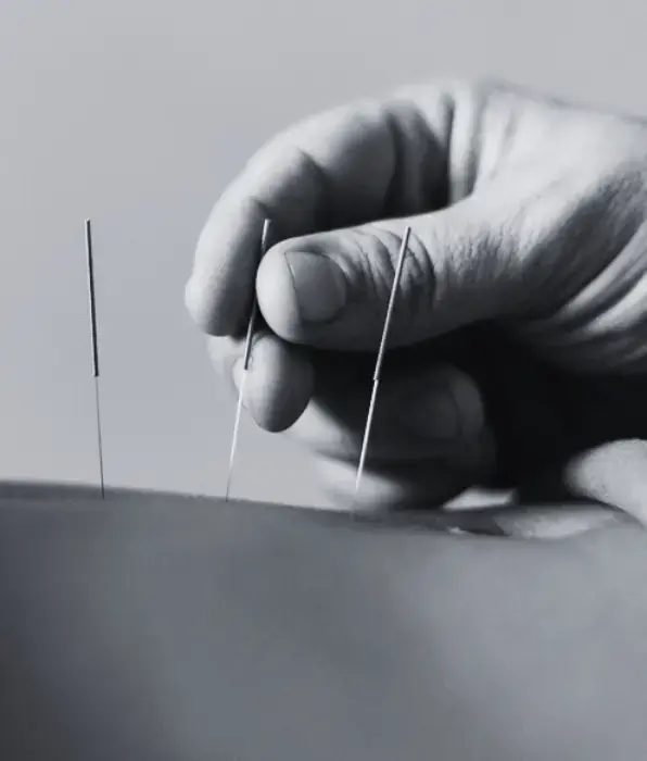 accupuncture